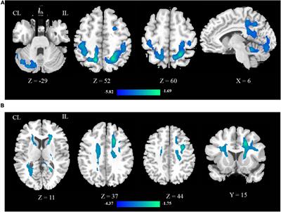 Repetitive Transcranial Magnetic Stimulation Induces Quantified Functional and Structural Changes in Subcortical Stroke: A Combined Arterial Spin Labeling Perfusion and Diffusion Tensor Imaging Study